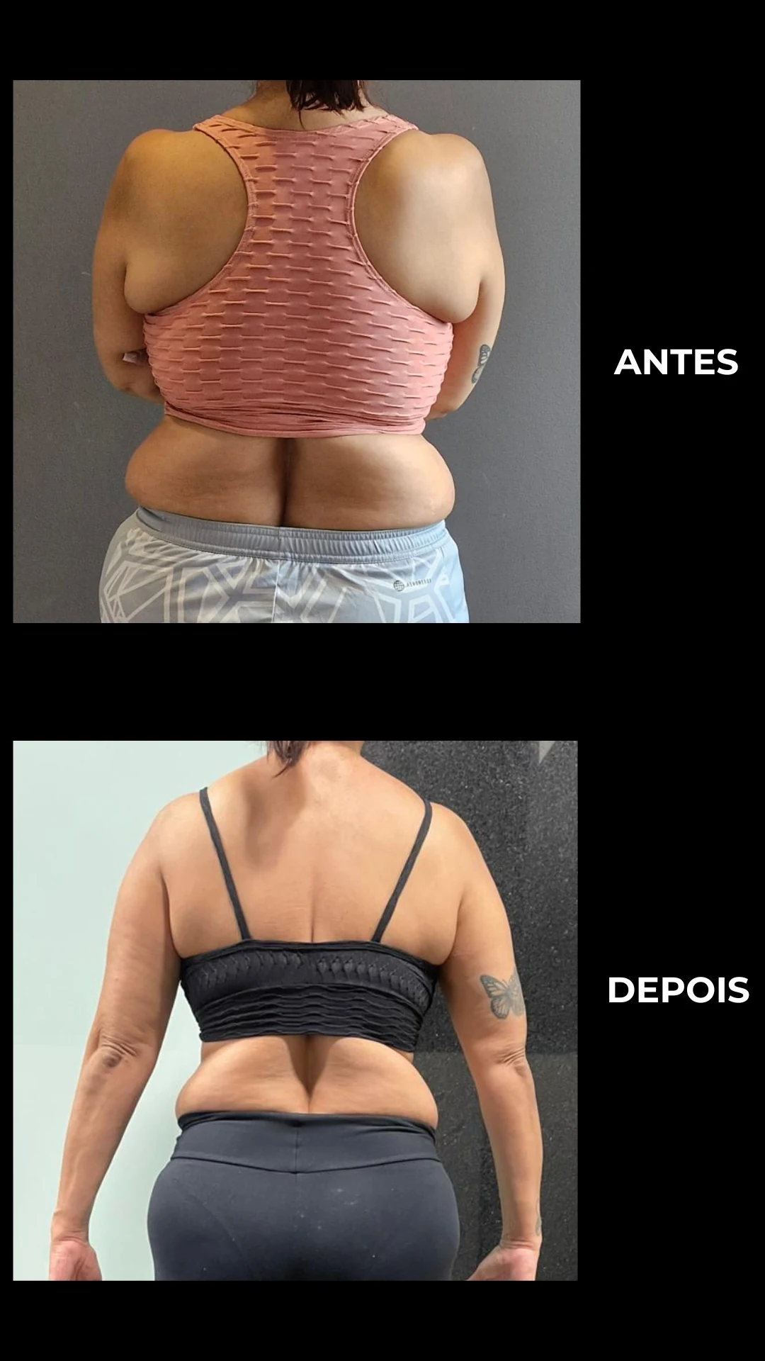 Comparativo antes e depois de costas, mostrando ombros mais alinhados